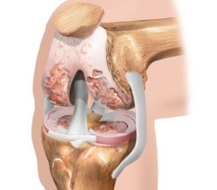 The cartilage of the knee